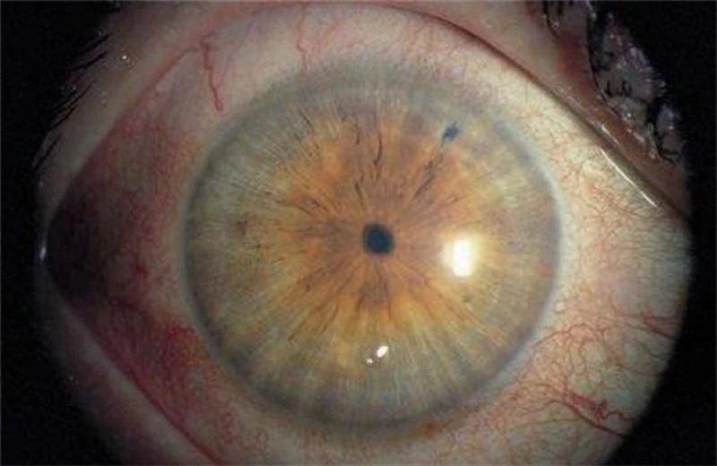 красные зрачки наркоманов.webp