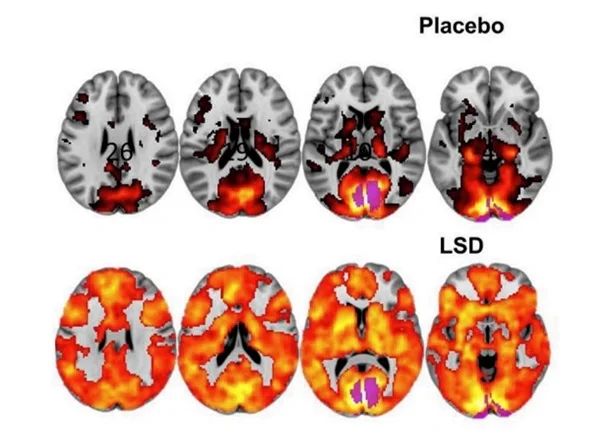Мозг человека под LSD в исследовании с МРТ.webp